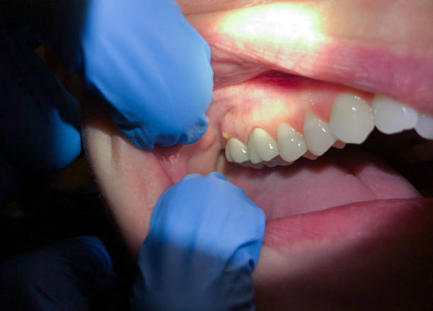 Best Emergency Dental Care for Abscessed Tooth in Mystic Island, NJ